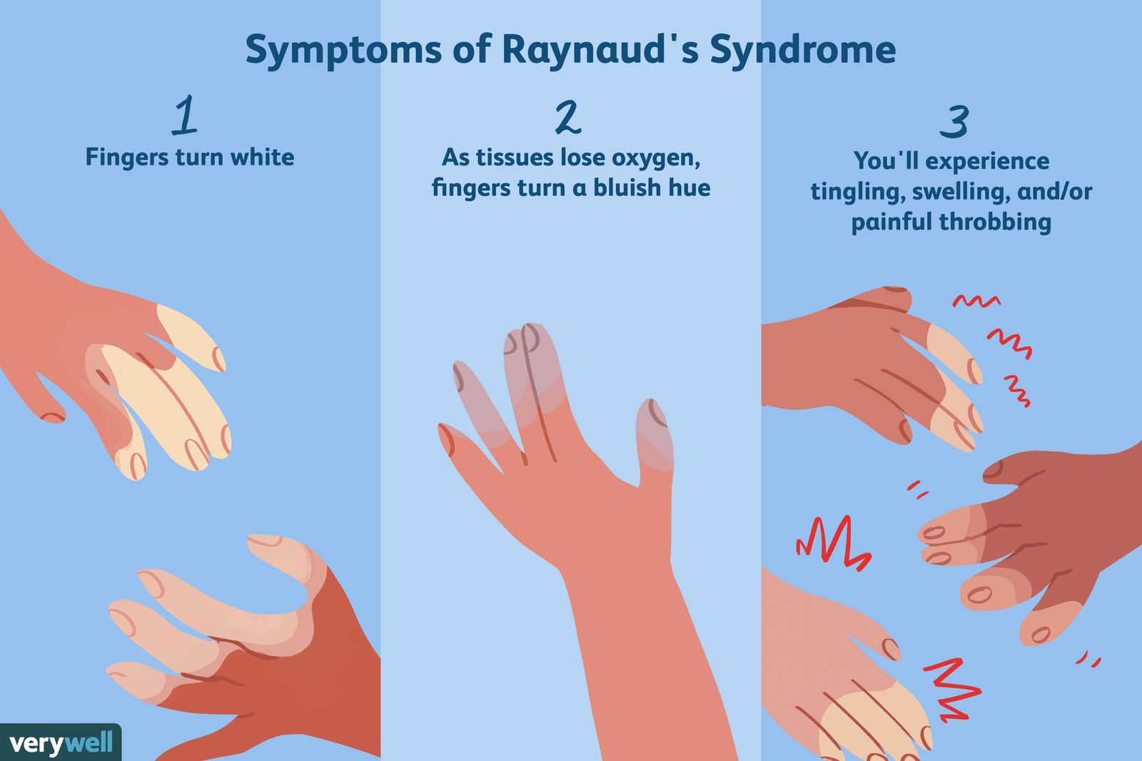 Reynaud's Disease - Heat Treatment